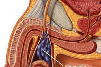 Влияет ли на зачатие варикоцеле у мужчин и какая вероятность забеременеть после операции по удалению вен гроздьевидного сплетения