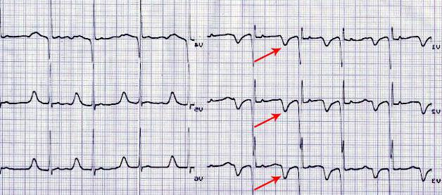 Экг отрицательный. Коронарный зубец т на ЭКГ. Отрицательный зубец т в v4-v6 отведениях. Отрицательный зубец т на ЭКГ v4-v6. Отрицательный зубец т на ЭКГ В 1 отведении.