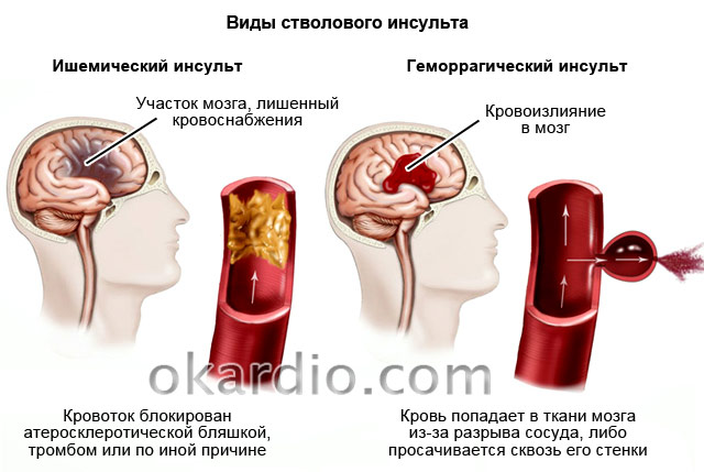 Кровоизлияние ствола мозга. Стволовой инсульт геморрагический. Стволовой ишемический инсульт головного мозга. Кровоизлияние в ствол головного мозга ишемический инсульт. Ишемического инсульта ствола мозга симптомы.